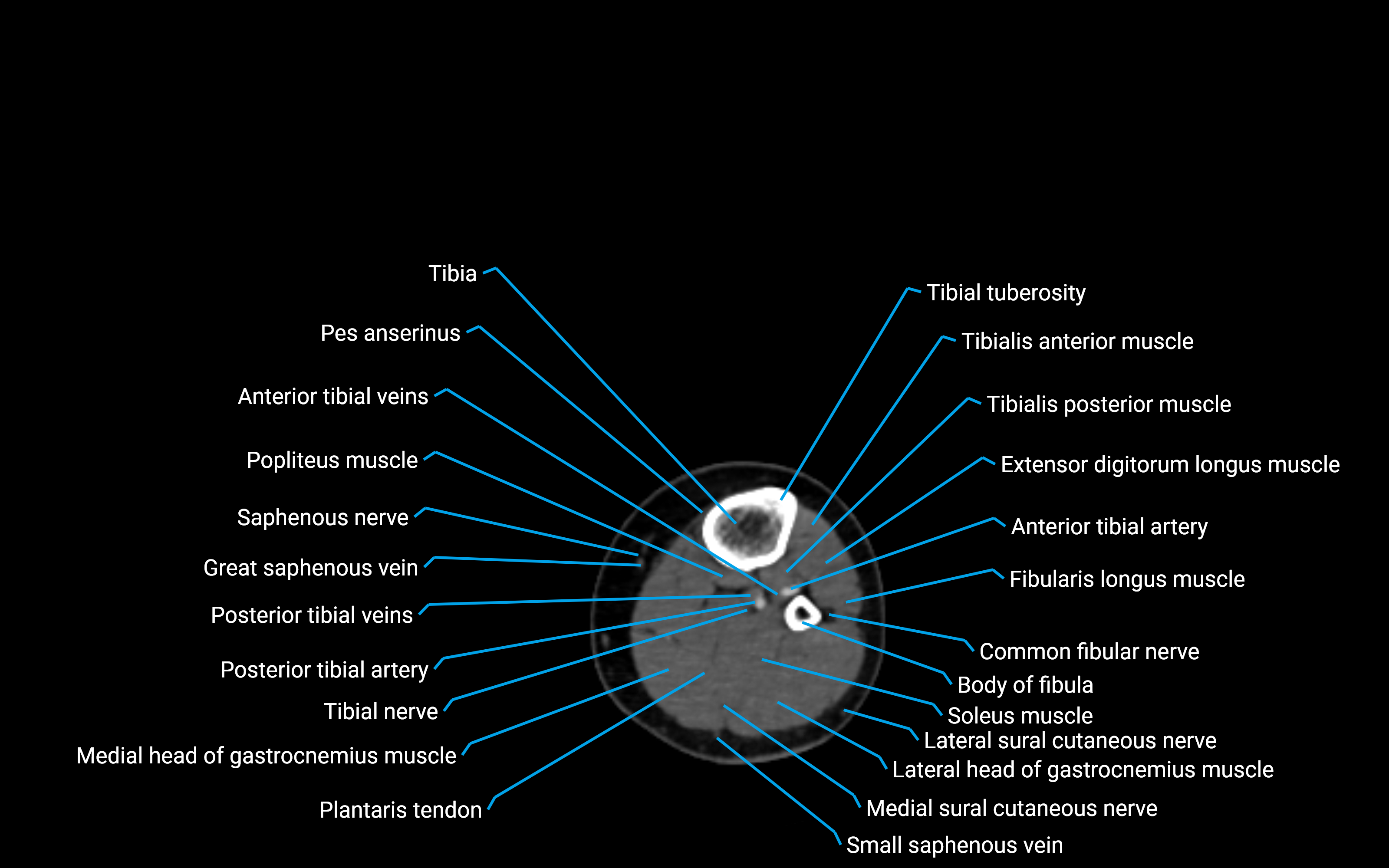 CT Lower leg axial cross sectional anatomy labelled image 102 (2).png